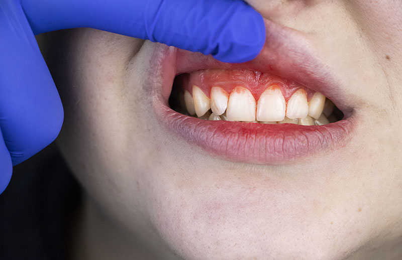 روش های قطع فوری خونریزی دندان