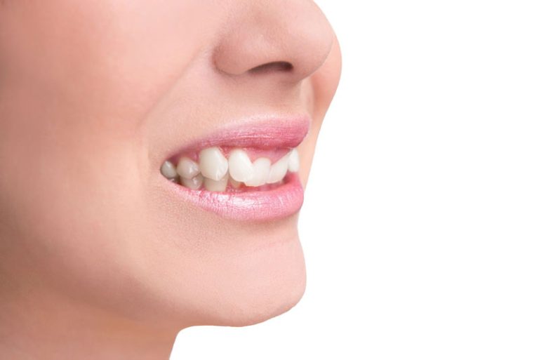 دندان های نابرابر و تاثیر آن بر دهان و فک